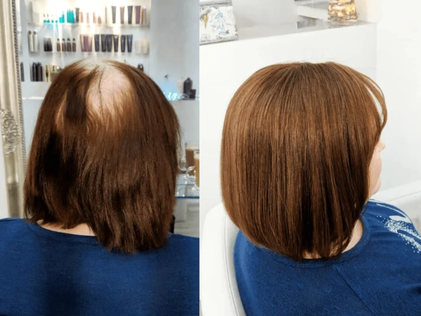 Hair thinning transformation