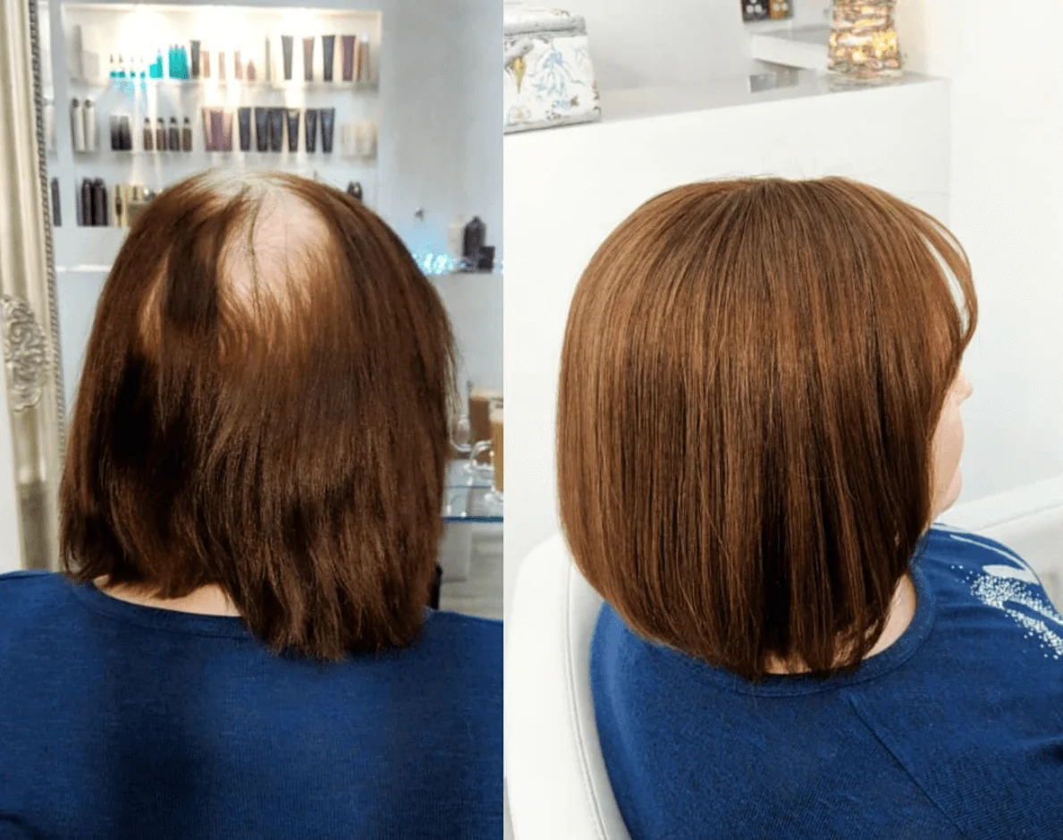 Hair thinning transformation